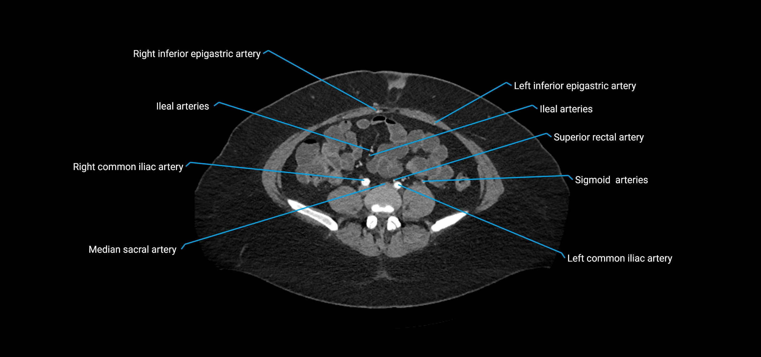 CTA abdomen axial cross sectional anatomy labelled image_155 (2).webp